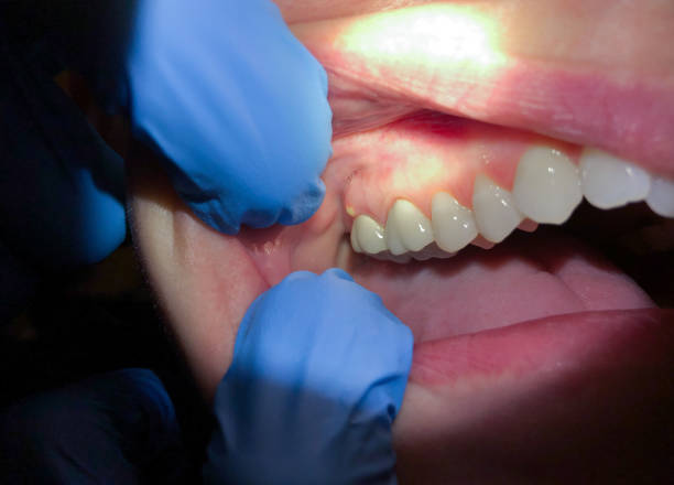 Best Emergency Root Canal Therapy in Timberlane, IL